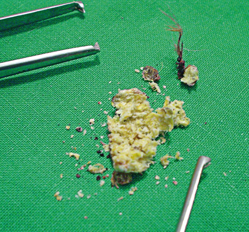 Para proceder a la eliminación indirecta del lump, atamos a su base un hilo de sutura, con el fin de bloquear la circulación de la sangre. Al cabo de 5 o 6 días, el lump se separa y cae el sólo, dejando una cicatriz más o menos evidente.